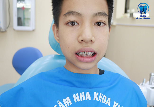Chỉnh nha và những vấn đề cần biết!