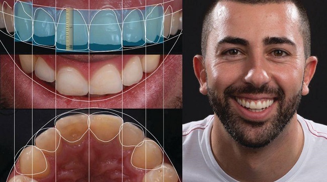 Digital Smile Design - Thiết kế nụ cười kỹ thuật số