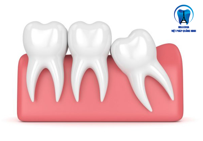 Nhổ răng số 8 có đau không? Những điều cần lưu ý khi nhổ răng số 8.