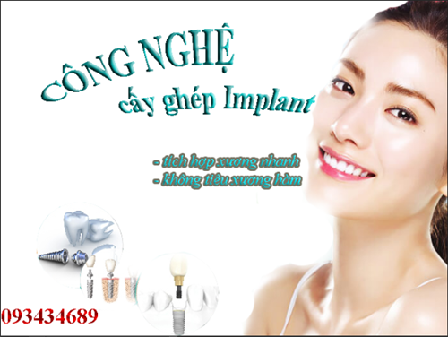 Cấy ghép răng implant