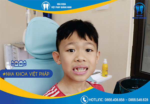 Chỉnh nha và những vấn đề cần biết!