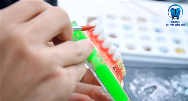 Digital Smile Design ( Thiết kế nụ cười kỹ thuật số ) là gì?